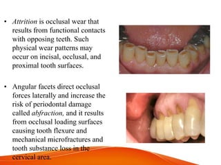 • Attrition is occlusal wear that
results from functional contacts
with opposing teeth. Such
physical wear patterns may
occur on incisal, occlusal, and
proximal tooth surfaces.
• Angular facets direct occlusal
forces laterally and increase the
risk of periodontal damage
called abfraction, and it results
from occlusal loading surfaces
causing tooth flexure and
mechanical microfractures and
tooth substance loss in the
cervical area.
 