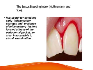 TheSulcusBleedingIndex (Mulhlemann and
Son).
• It is useful for detecting
early inflammatory
changes and presence
of inflammatory lesions
located at base of the
periodontal pocket, an
area inaccessible to
visual examination.
 