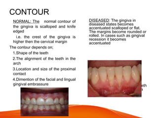 CONTOUR
 NORMAL: The normal contour of
the gingiva is scalloped and knife
edged
i.e. the crest of the gingiva is
higher then the cervical margin
The contour depends on;
1.Shape of the teeth
2.The alignment of the teeth in the
arch
3.Location and size of the proximal
contact
4.Dimention of the facial and lingual
gingival embrassure
 DISEASED: The gingiva in
diseased states becomes
accentuated scalloped or flat.
The margins become rounded or
rolled. In cases such as gingival
recession it becomes
accentuated
 In normal physiology when teeth
are lingually placed the gingiva
is horizontal and thickened
 