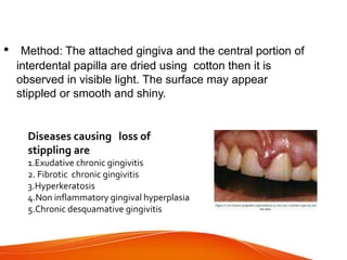 • Method: The attached gingiva and the central portion of
interdental papilla are dried using cotton then it is
observed in visible light. The surface may appear
stippled or smooth and shiny.
Diseases causing loss of
stippling are
1.Exudative chronic gingivitis
2. Fibrotic chronic gingivitis
3.Hyperkeratosis
4.Non inflammatory gingival hyperplasia
5.Chronic desquamative gingivitis
 