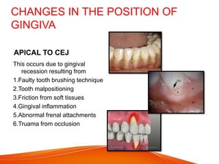CHANGES IN THE POSITION OF
GINGIVA
APICAL TO CEJ
This occurs due to gingival
recession resulting from
1.Faulty tooth brushing technique
2.Tooth malpositioning
3.Friction from soft tissues
4.Gingival inflammation
5.Abnormal frenal attachments
6.Truama from occlusion
 
