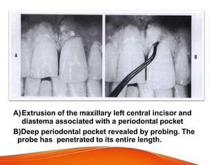 A)Extrusion of the maxillary left central incisor and
diastema associated with a periodontal pocket
B)Deep periodontal pocket revealed by probing. The
probe has penetrated to its entire length.
 