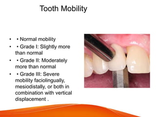 Tooth Mobility
• • Normal mobility
• • Grade I: Slightly more
than normal
• • Grade II: Moderately
more than normal
• • Grade III: Severe
mobility faciolingually,
mesiodistally, or both in
combination with vertical
displacement .
 