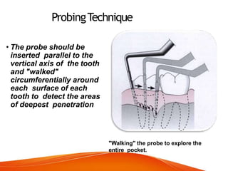 ProbingTechnique
• The probe should be
inserted parallel to the
vertical axis of the tooth
and "walked"
circumferentially around
each surface of each
tooth to detect the areas
of deepest penetration
"Walking" the probe to explore the
entire pocket.
 