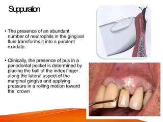 Suppuration
• The presence of an abundant
number of neutrophils in the gingival
fluid transforms it into a purulent
exudate.
• Clinically, the presence of pus in a
periodontal pocket is determined by
placing the ball of the index finger
along the lateral aspect of the
marginal gingiva and applying
pressure in a rolling motion toward
the crown
 