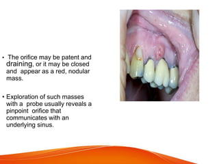 • The orifice may be patent and
draining, or it may be closed
and appear as a red, nodular
mass.
• Exploration of such masses
with a probe usually reveals a
pinpoint orifice that
communicates with an
underlying sinus.
 