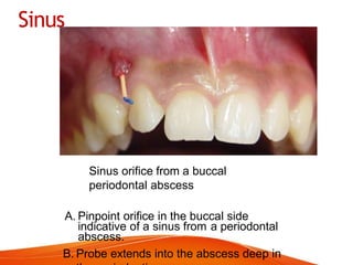 Sinus
Sinus orifice from a buccal
periodontal abscess
A. Pinpoint orifice in the buccal side
indicative of a sinus from a periodontal
abscess.
B. Probe extends into the abscess deep in
 