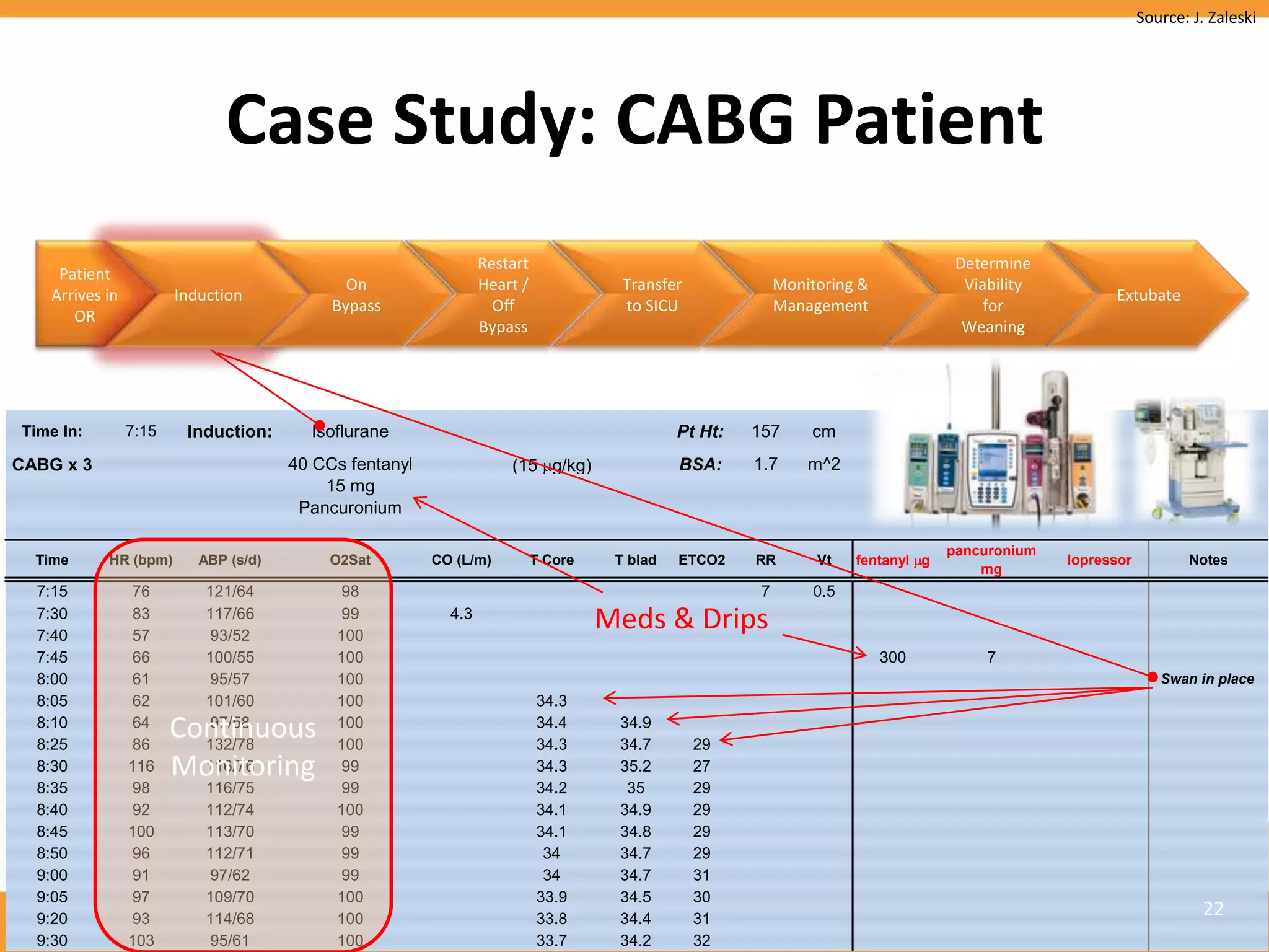 Source: J. Zaleski




                              Case Study: CABG Patient
                                                                 Restart                                                             Determine
     Patient
                                              On                 Heart /              Transfer              Monitoring &              Viability
    Arrives in          Induction                                                                                                                       Extubate
                                            Bypass                 Off                to SICU               Management                   for
       OR
                                                                 Bypass                                                               Weaning




Time In:         7:15    Induction:      Isoflurane                                           Pt Ht:   157      cm
CABG x 3                               40 CCs fentanyl               (15 g/kg)                BSA:     1.7      m^2
                                           15 mg
                                        Pancuronium

                                                                                                                                    pancuronium
  Time      HR (bpm)       ABP (s/d)        O2Sat        CO (L/m)          T Core    T blad   ETCO2    RR        Vt    fentanyl g                 lopressor          Notes
                                                                                                                                        mg
  7:15       76             121/64          98                                                          7        0.5
  7:30
  7:40
             83
             57
                            117/66
                             93/52
                                            99
                                            100
                                                           4.3
                                                                                    Meds & Drips
  7:45       66             100/55          100                                                                            300           7
  8:00       61              95/57          100                                                                                                                  Swan in place
  8:05       62             101/60          100                            34.3
  8:10
  8:25
             64
             86
                        Continuous
                             97/58
                            132/78
                                            100
                                            100
                                                                           34.4
                                                                           34.3
                                                                                     34.9
                                                                                     34.7        29
  8:30      116         Monitoring
                            116/76          99                             34.3      35.2        27
  8:35       98             116/75          99                             34.2       35         29
  8:40       92             112/74          100                            34.1      34.9        29
  8:45      100             113/70          99                             34.1      34.8        29
  8:50       96             112/71          99                              34       34.7        29
  9:00       91              97/62          99                              34       34.7        31
  9:05       97             109/70          100                            33.9      34.5        30
  9:20       93             114/68          100                            33.8      34.4        31
                                                                                                                                                                        22
Sunday, May 29, 2011
  9:30      103              95/61          100                            33.7      34.2        32
 