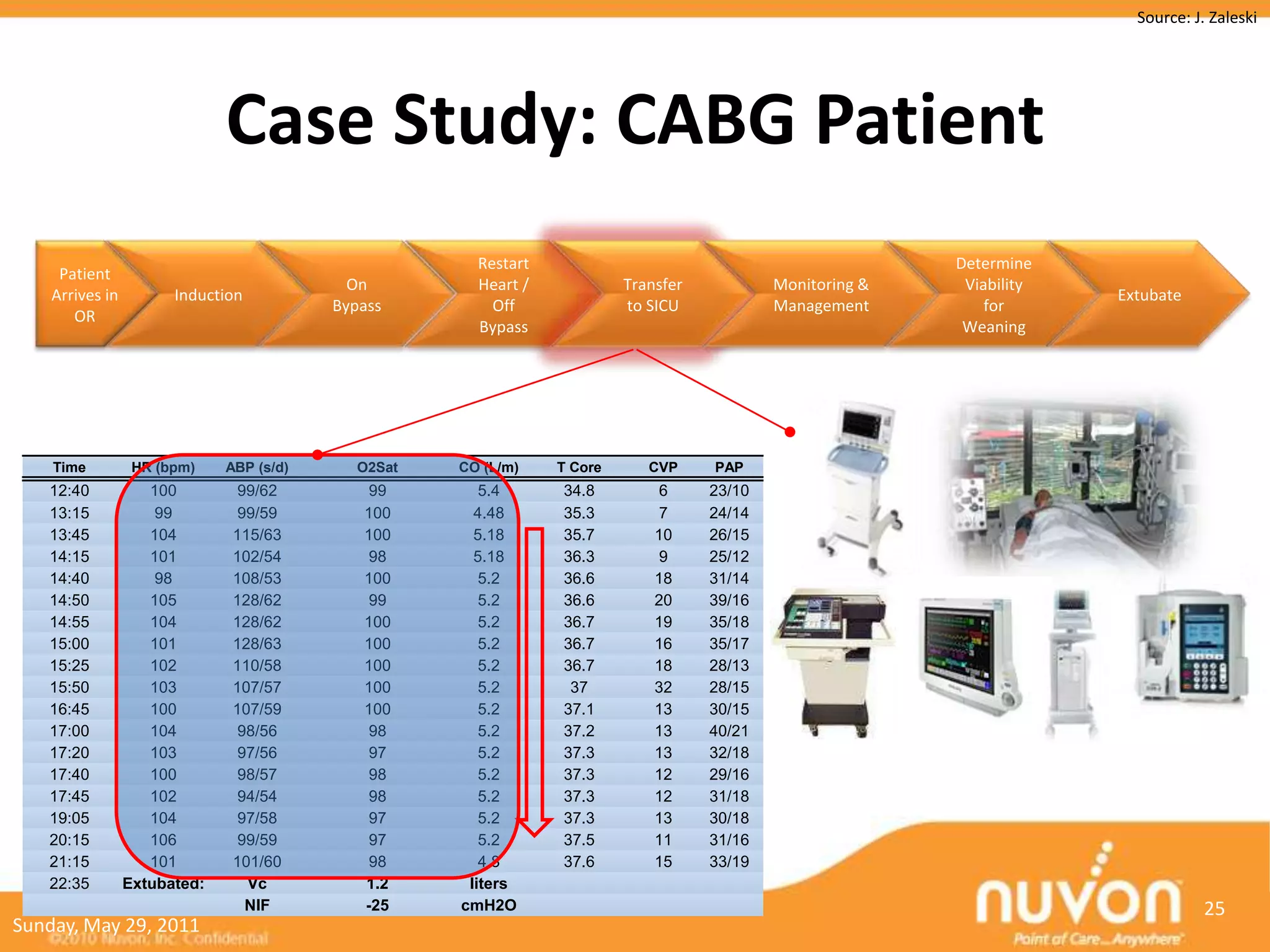 Source: J. Zaleski




                              Case Study: CABG Patient
                                                       Restart                                              Determine
     Patient
                                            On         Heart /            Transfer           Monitoring &    Viability
    Arrives in         Induction                                                                                         Extubate
                                          Bypass         Off              to SICU            Management         for
       OR
                                                       Bypass                                                Weaning




    Time          HR (bpm)    ABP (s/d)      O2Sat   CO (L/m)    T Core      CVP     PAP
   12:40            100         99/62         99        5.4      34.8          6     23/10
   13:15             99         99/59        100       4.48      35.3          7     24/14
   13:45            104        115/63        100       5.18      35.7         10     26/15
   14:15            101        102/54         98       5.18      36.3          9     25/12
   14:40             98        108/53        100        5.2      36.6         18     31/14
   14:50            105        128/62         99        5.2      36.6         20     39/16
   14:55            104        128/62        100        5.2      36.7         19     35/18
   15:00            101        128/63        100        5.2      36.7         16     35/17
   15:25            102        110/58        100        5.2      36.7         18     28/13
   15:50            103        107/57        100        5.2       37          32     28/15
   16:45            100        107/59        100        5.2      37.1         13     30/15
   17:00            104         98/56         98        5.2      37.2         13     40/21
   17:20            103         97/56         97        5.2      37.3         13     32/18
   17:40            100         98/57         98        5.2      37.3         12     29/16
   17:45            102         94/54         98        5.2      37.3         12     31/18
   19:05            104         97/58         97        5.2      37.3         13     30/18
   20:15            106         99/59         97        5.2      37.5         11     31/16
   21:15            101        101/60         98        4.8      37.6         15     33/19
   22:35         Extubated:      Vc          1.2      liters
                                 NIF         -25     cmH2O                                                                           25
Sunday, May 29, 2011
 