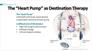 2
The“HeartPump”
LVAD (leftventricular assist device),
implantable mechanical heart pump.
Adiﬃcultend-of-lifedecision
•  High-risk surgery and recovery
•  Lifestyle change
•  Critical implantwindow
The “Heart Pump” as DestinationTherapy
Source: www.mayoclinic.org
Background
 
