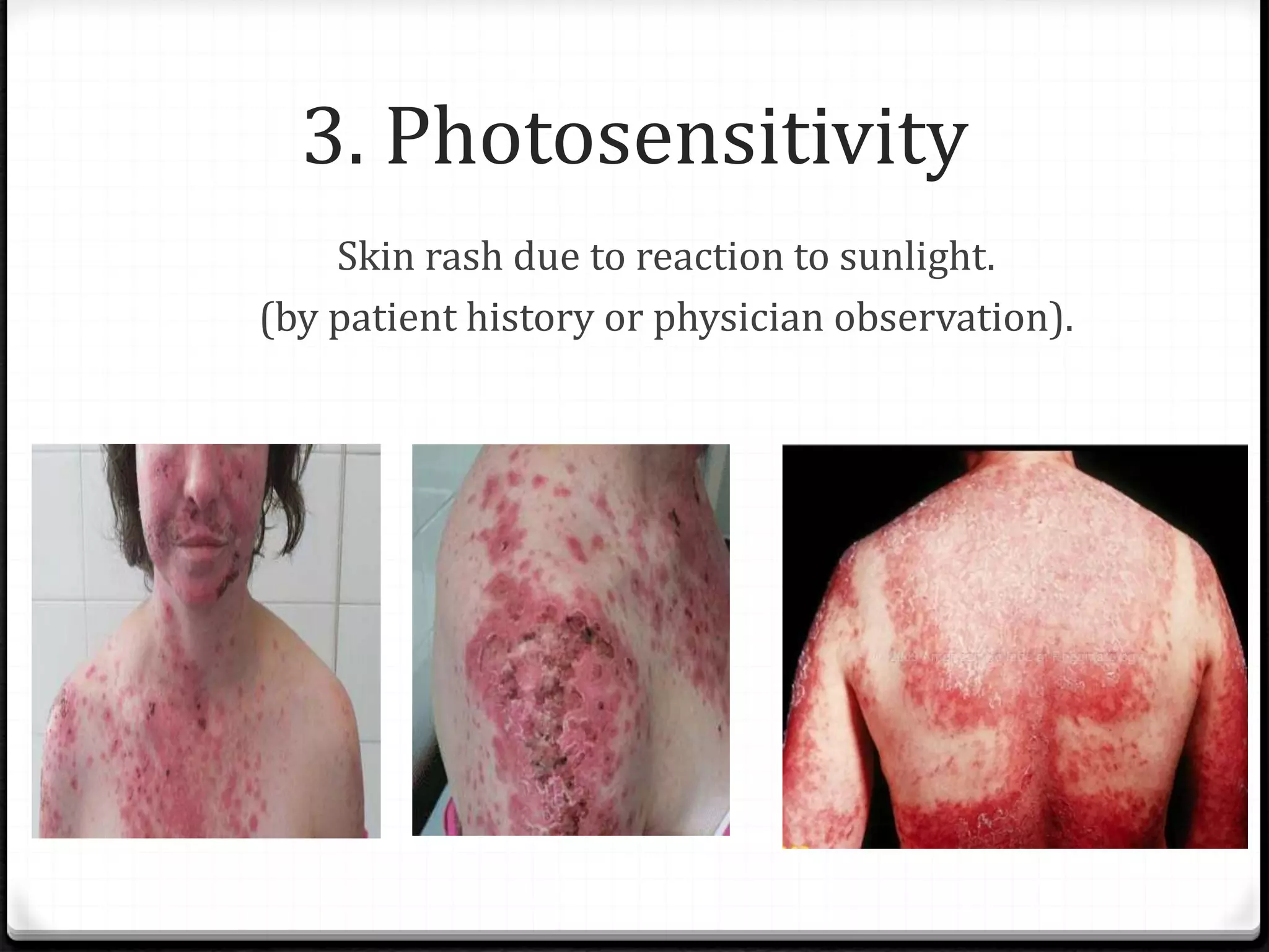 Clinical diagnosis of systemic lupus erythematosus | PDF