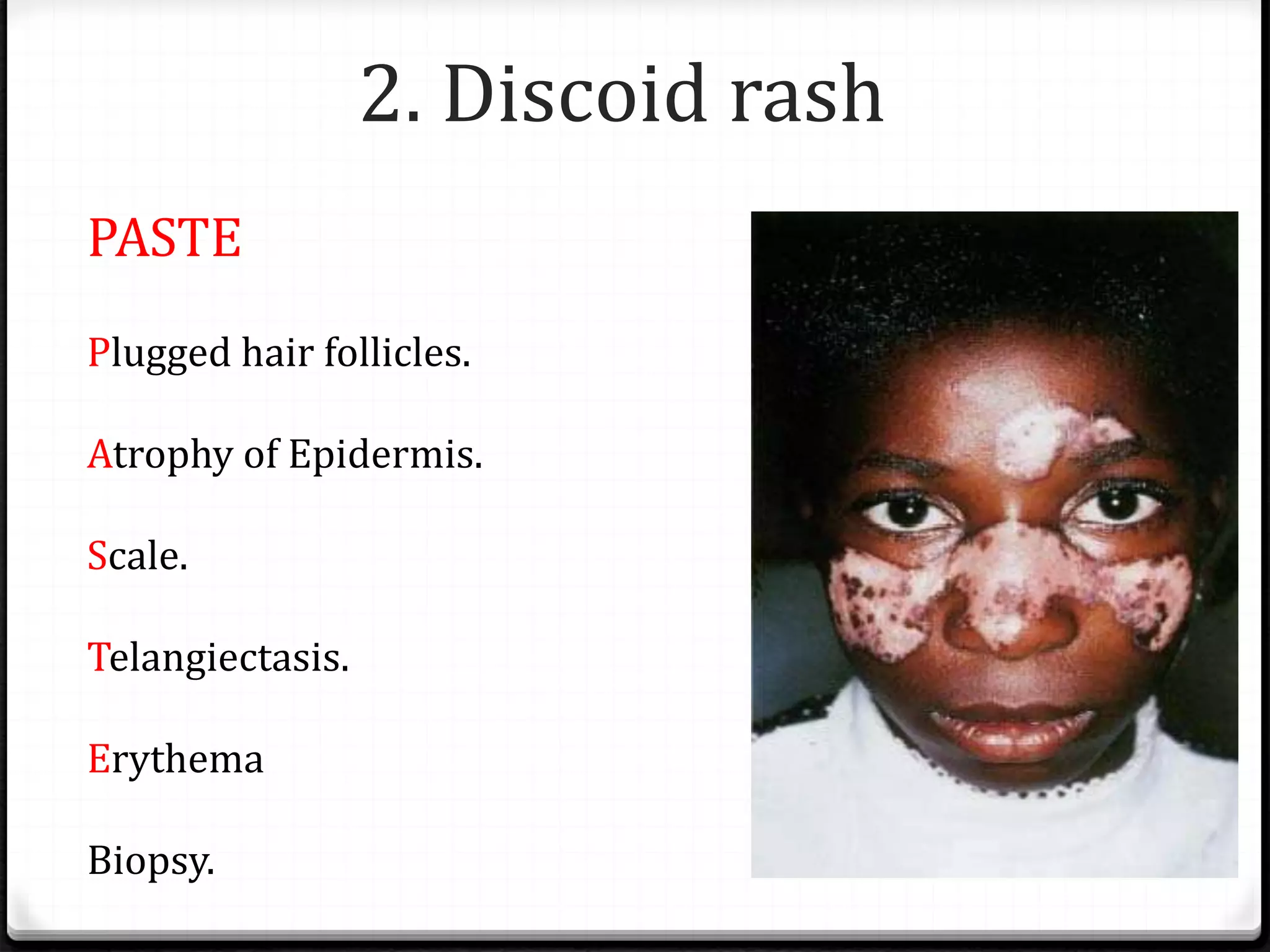 Clinical diagnosis of systemic lupus erythematosus | PDF