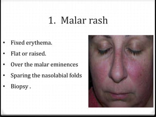 Malar Rash Pattern Clinical diagnosis of systemic lupus erythematosus | PDF