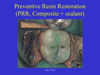 Prr Tooth Clinical Diagnosis of Tooth Defects and Treatment Plan.ppt