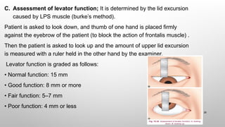 CLINICAL EVALUATION AND MANAGEMENT OPTION OF AQUIRED PTOSIS [Autosaved ...