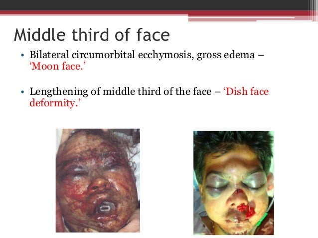 Clinical Evaluation in Maxillofacial Trauma