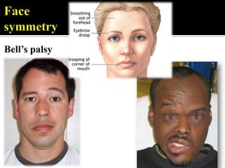 Bell’s palsy
 