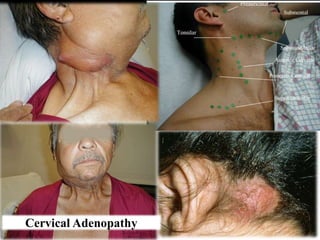 Cervical Adenopathy
 