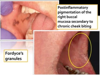 Postinflammatory
            pigmentation of the
            right buccal
            mucosa secondary to
            chronic cheek biting




Fordyce’s
granules
 