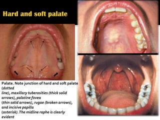 Palate. Note junction of hard and soft palate
(dotted
line), maxillary tuberosities (thick solid
arrows), palatine fovea
(thin solid arrows), rugae (broken arrows),
and incisive papilla
(asterisk). The midline raphe is clearly
evident
 
