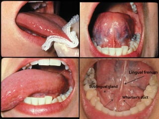 Lingual frenum


Sublingual gland

                   Whartan’s duct
 