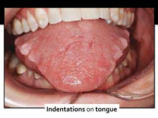 Indentations on tongue
 