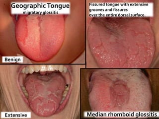 Geographic Tongue            Fissured tongue with extensive
                               grooves and fissures
         migratory glossitis
                               over the entire dorsal surface.




Benign




Extensive                      Median rhomboid glossitis
 