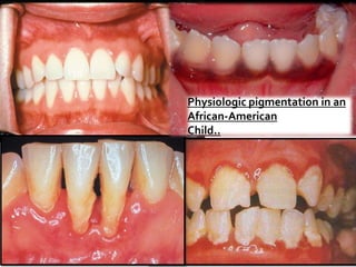 Physiologic pigmentation in an
African-American
Child..
 