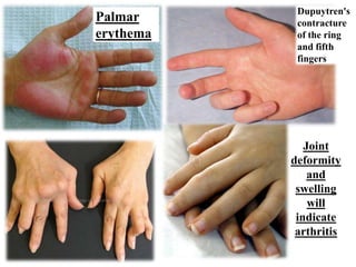 Dupuytren's
Palmar      contracture
erythema    of the ring
            and fifth
            fingers




              Joint
           deformity
               and
            swelling
               will
            indicate
            arthritis
 