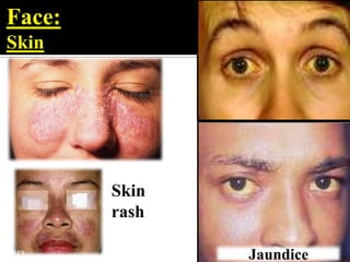 Face:
Skin




        Skin
        rash

               Jaundice
 