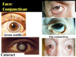 Arcus senilis   Pale conjunctivae




Cataract
 