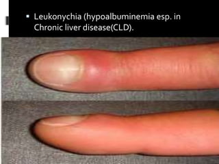  Leukonychia (hypoalbuminemia esp. in
Chronic liver disease(CLD).
 