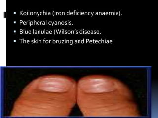  Koilonychia (iron deficiency anaemia).
 Peripheral cyanosis.
 Blue lanulae (Wilson’s disease.
 The skin for bruzing and Petechiae
 