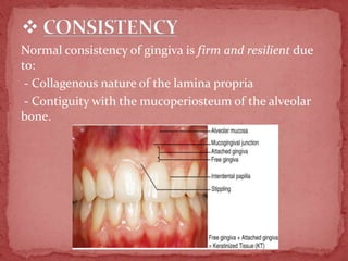 Normal Gingiva Clinical examination of gingiva | PPTX