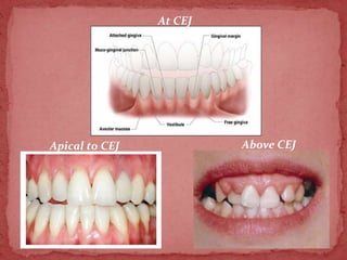 Clinical examination of gingiva | PPTX