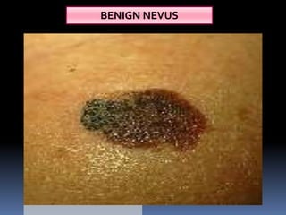 Nevus Simplex Raised Clinical examination of swelling | PPTX