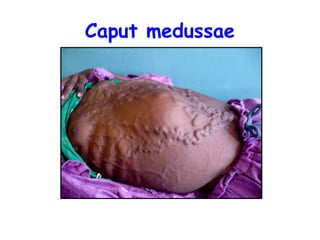 Caput Med Clinical examination of thye abdomen.pptx