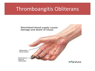 Thromboangitis Obliterans
 
