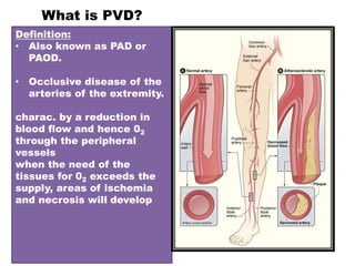 What is PVD?
Definition:
• Also known as PAD or
PAOD.
• Occlusive disease of the
arteries of the extremity.
charac. by a reduction in
blood flow and hence 02
through the peripheral
vessels
when the need of the
tissues for 02 exceeds the
supply, areas of ischemia
and necrosis will develop
 