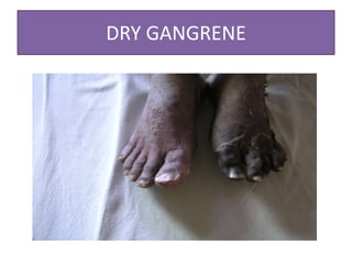 DRY GANGRENE
 