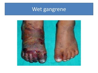Wet gangrene
 