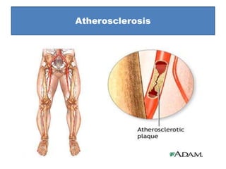 Atherosclerosis
 
