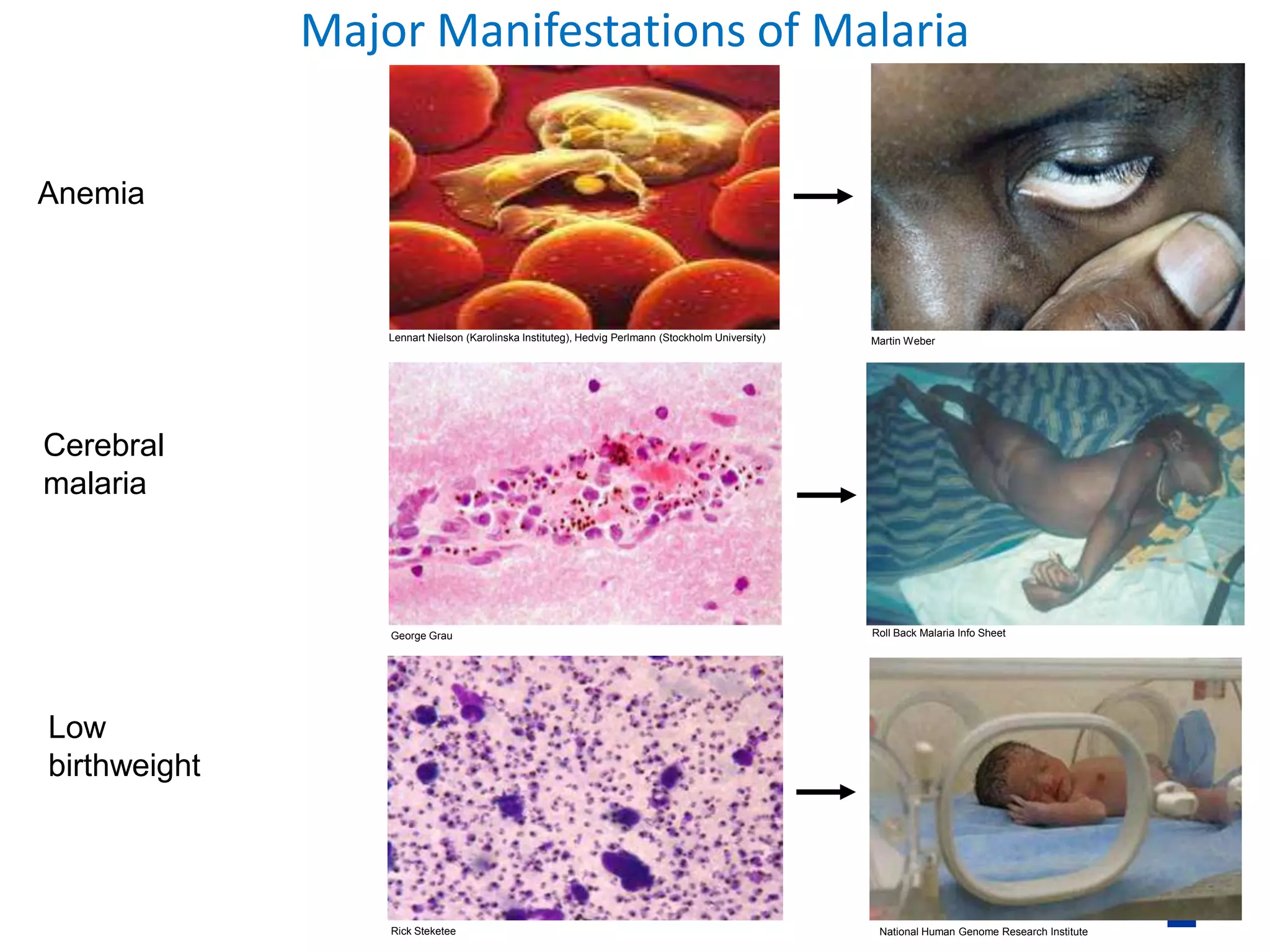 CLINICAL FEATURES AND COMPLICATIONS OF MALARIA | PPTX