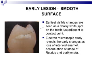 Tooth Retzius Clinical features and histopathology of dental caries | PPT