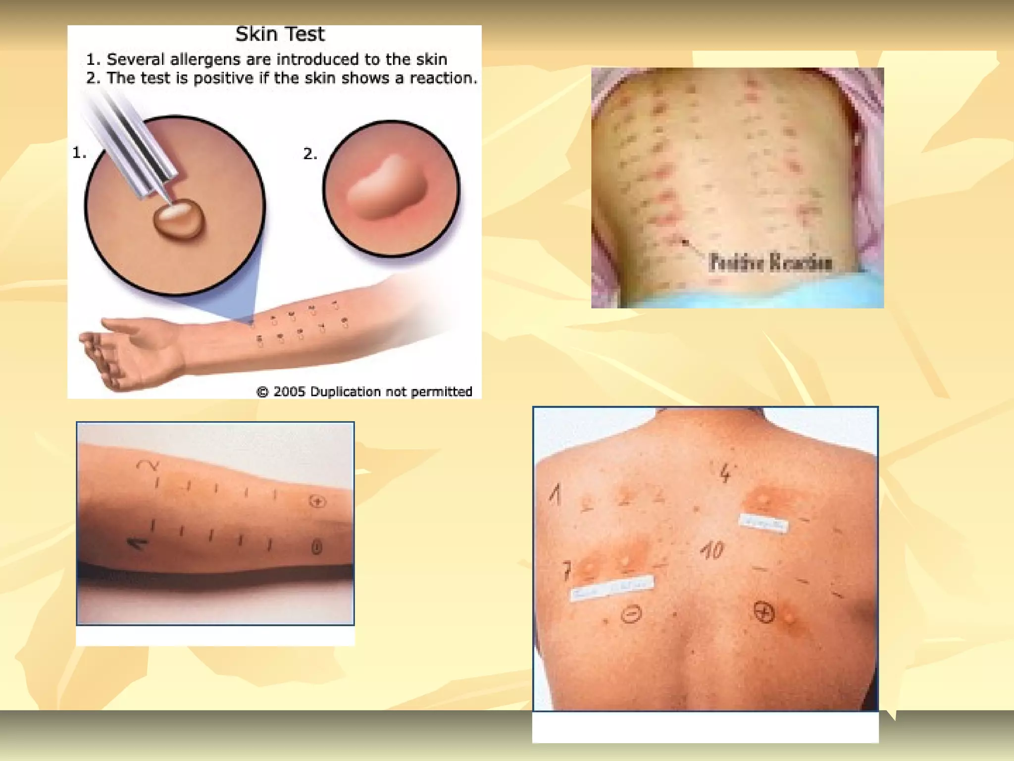 Clinical features and investigations of allergic rhinitis | PPT