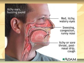 Clinical features and investigations of allergic rhinitis | PPT