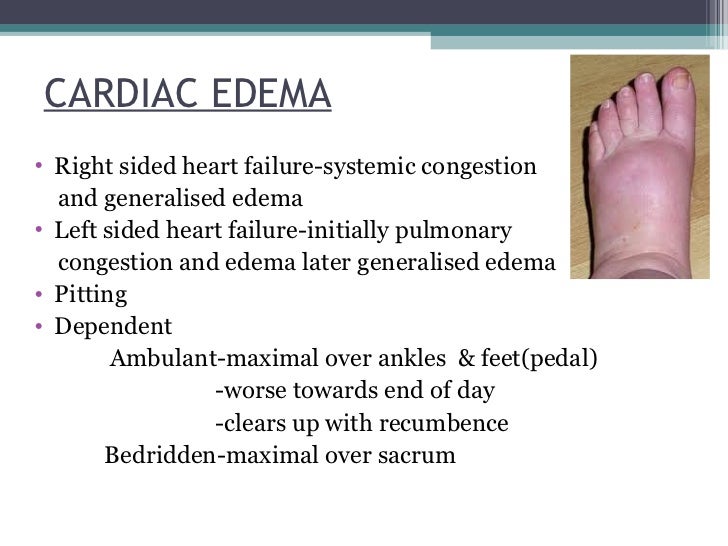 Clinical features of edema