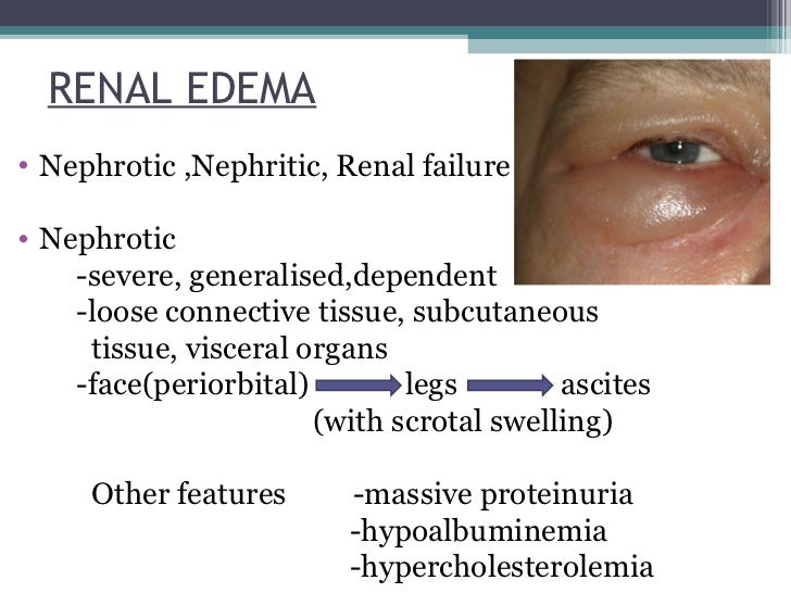 Clinical features of edema
