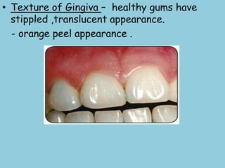 • Texture of Gingiva – healthy gums have
stippled ,translucent appearance.
- orange peel appearance .
 