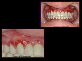 Clinical features ofgingivitis. periodontics | PPT